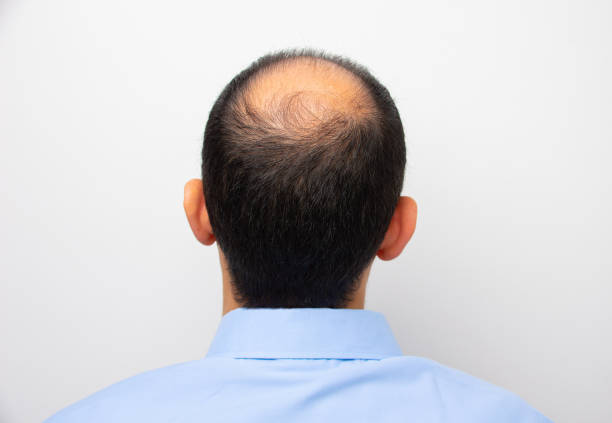 What is DHT and Why Does it Cause Hair Loss